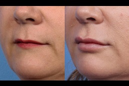 best lip-enlargement-cost in dubai