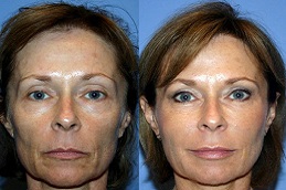 best liquid-facelift-cost in dubai
