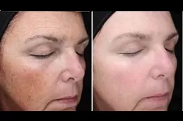 best pigmentation-laser-treatment-cost in dubai
