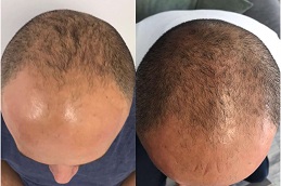 best regenera-activa-treatment-cost in dubai