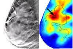 Breast Cancer Screening Cost