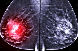 Breast Cancer Screening Cost Dubai