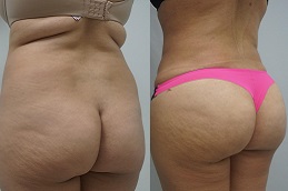 buttock-doctor in Abu Dhabi