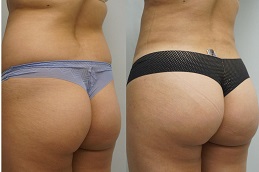 buttock-doctor in dubai