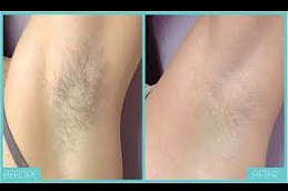 can-you-go-swimming-after-getting-laser-hair-removal Clinic in Dubai