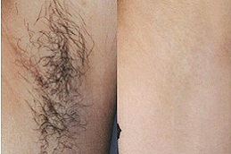 can-you-go-swimming-after-getting-laser-hair-removal in Abu Dhabi