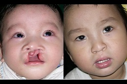 cleft-lip-and-palate-surgery-cost Clinic in Dubai