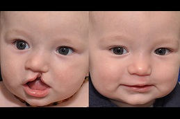 cleft-lip-and-palate-surgery-cost in Abu Dhabi