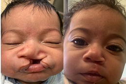 cleft-lip-and-palate-surgery-cost in dubai