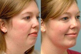 double-chin-removal-cost Clinic in Dubai