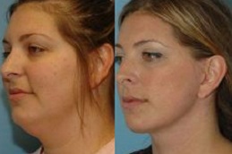 double-chin-removal-cost in Abu Dhabi