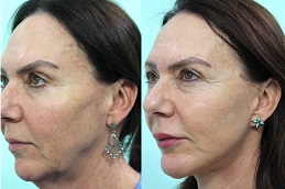 double-chin-removal-cost in dubai