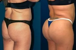 french-butt-reshaping-cost in Abu Dhabi