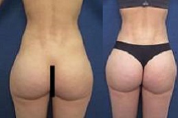 french-butt-reshaping-cost in dubai
