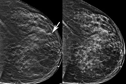 mammogram-cost-in-dubai