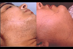 is-laser-hair-removal-cancerous Clinic in Dubai