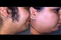 is-laser-hair-removal-cancerous in Abu Dhabi