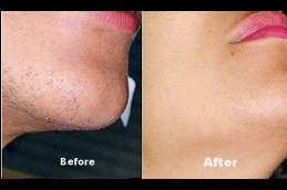 is-laser-hair-removal-cancerous in dubai