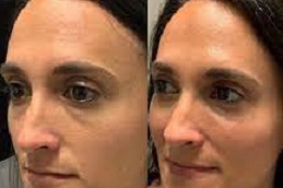 jawline fillers cost