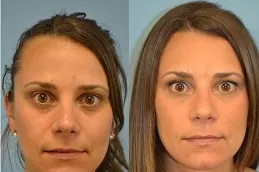  Best jawline fillers cost Dubai