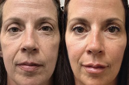 jawline-fillers-cost in dubai