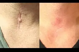 keloid-removal-treatment-pros-and-cons Clinic in Dubai
