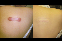 keloid-removal-treatment-pros-and-cons in dubai
