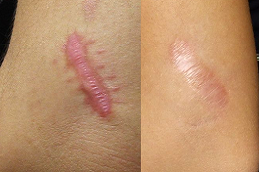 keloid-removal-treatment-pros-and-consin Abu Dhabi