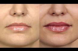 lip-enlargement-cost Clinic in Dubai