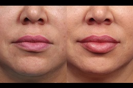lip-enlargement-cost in Abu Dhabi