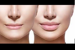 lip-enlargement-cost in dubai