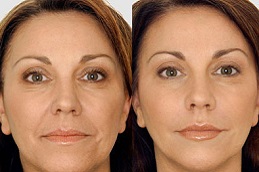 liquid-facelift-cost Clinic in Dubai