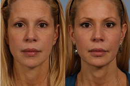 liquid-facelift-cost in Abu Dhabi