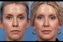 liquid-facelift-cost in dubai