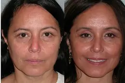 makeover-cosmetic-surgery-cost in Abu Dhabi