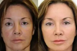 makeover-cosmetic-surgery-cost in dubai