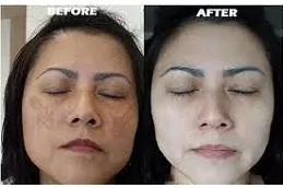 pigmentation-laser-treatment-cost Clinic in Dubai