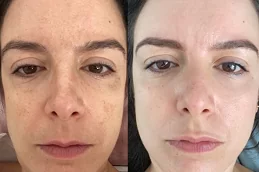 pigmentation-laser-treatment-cost in Abu Dhabi