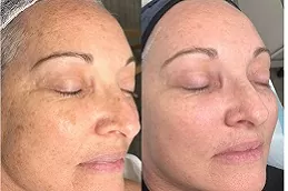 pigmentation-laser-treatment-cost in dubai