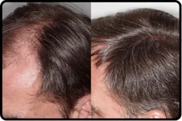 regenera-activa-treatment-cost in Abu Dhabi