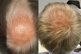 regenera-activa-treatment-cost in dubai