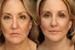 sunekos-injections-cost Clinic in Dubai
