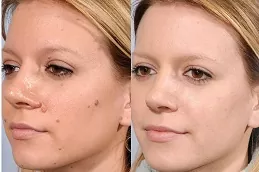 sunekos-injections-cost in Abu Dhabi