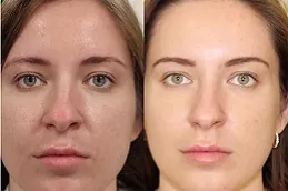 sunekos-injections-cost in dubai