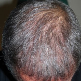 ACell PRP Cost in Dubai