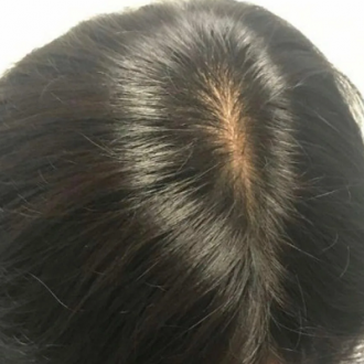 ACell Injections for Hair Growth in Dubai