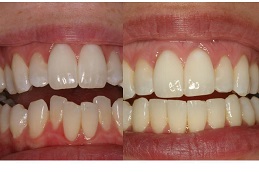 Aligners in Abu Dhabi