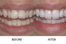 Aligners in Dubai