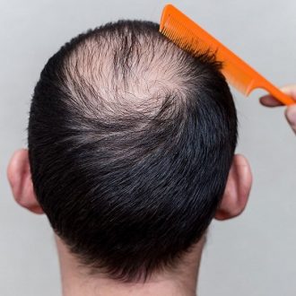 Baldness Treatment Cost in Dubai & Abu Dhabi