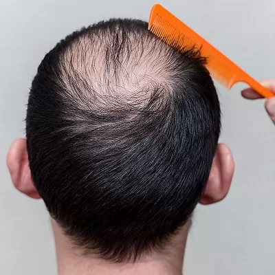 Baldness Treatment Cost in Dubai, Abu Dhabi & Sharjah Price